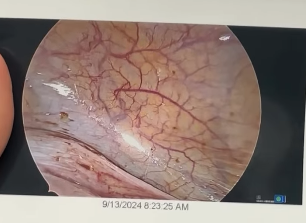 Ovarian-endometrioma-chocolate-cyst